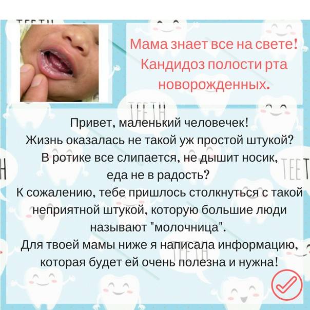 Кандидоз полости рта у детей: причины, лечение