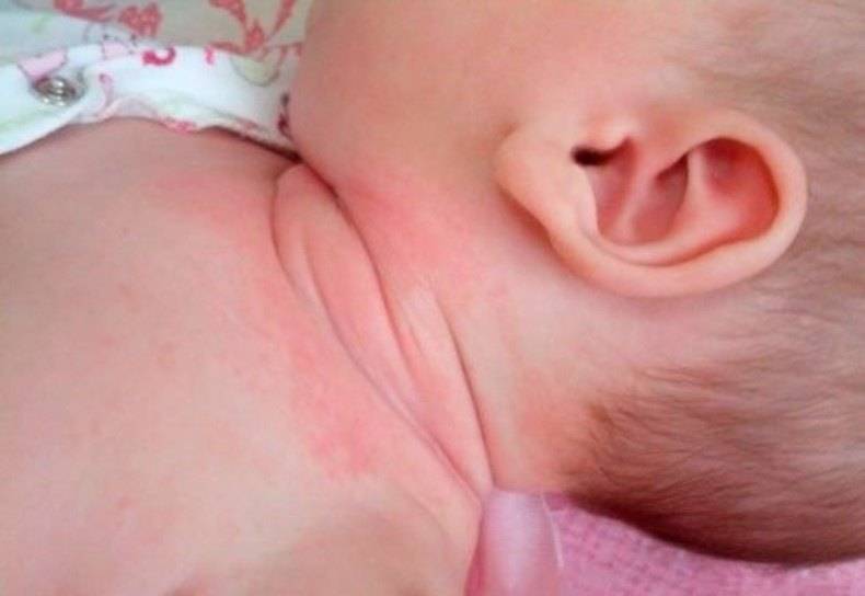 Лечение потницы на лице у новорожденного