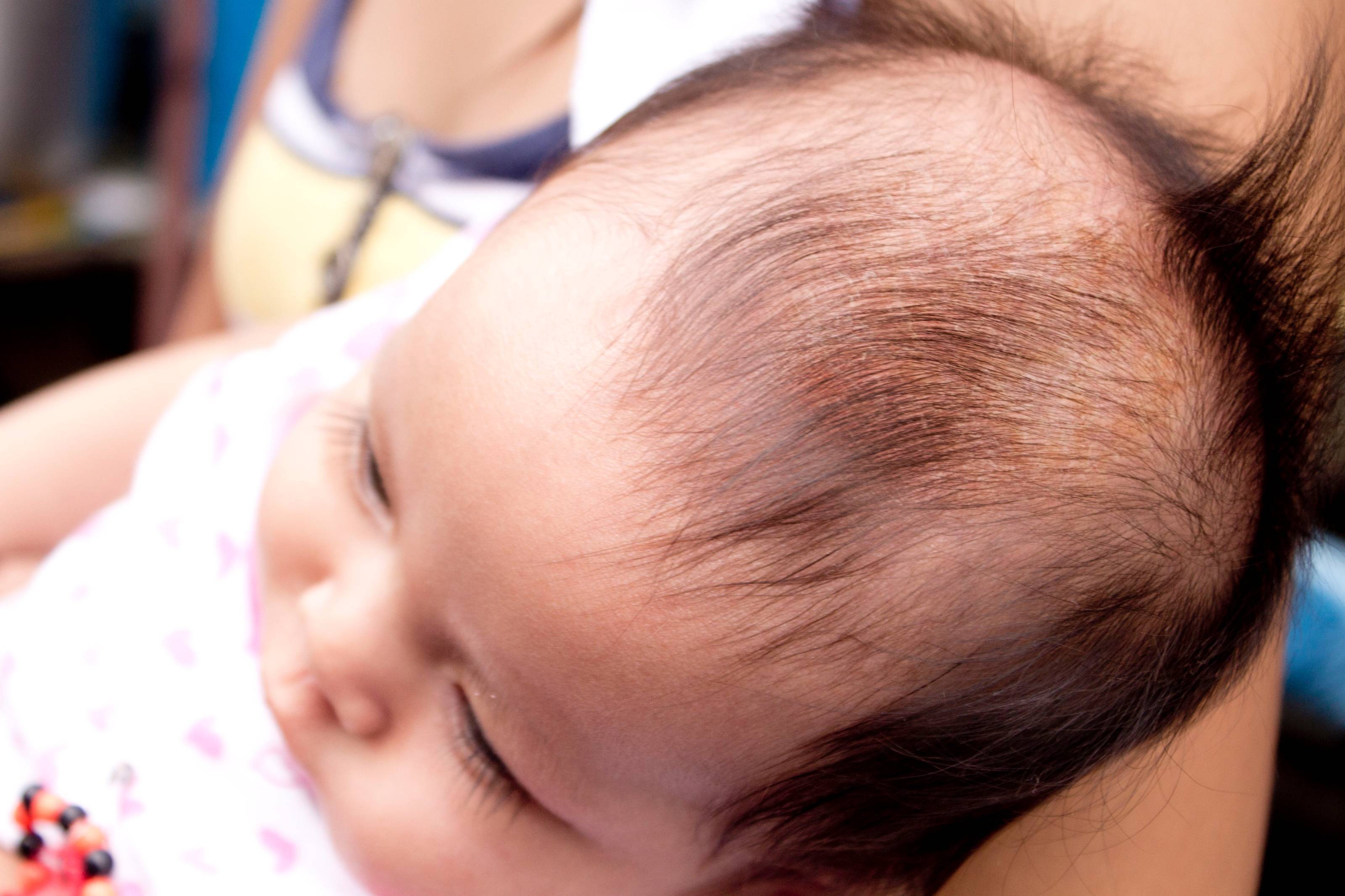 Себорея на голове у детей: причины, лечение, шампунь