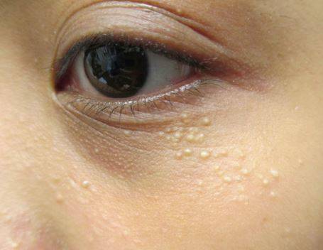 Сыпь на коже: как по высыпаниям определить, чем болеет человек