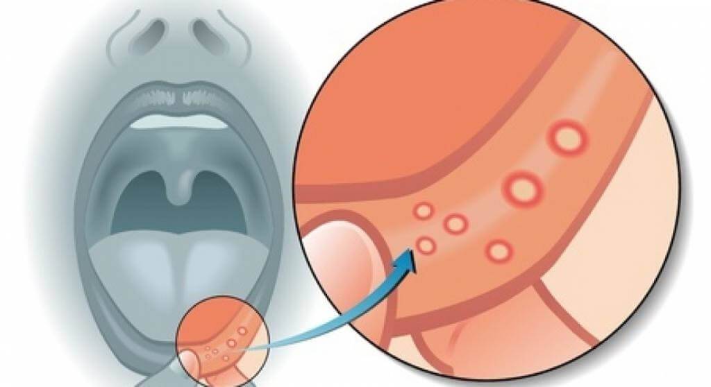 Сыпь с температурой: причины, лечение - симптомы болезни и признаки заболеваний
