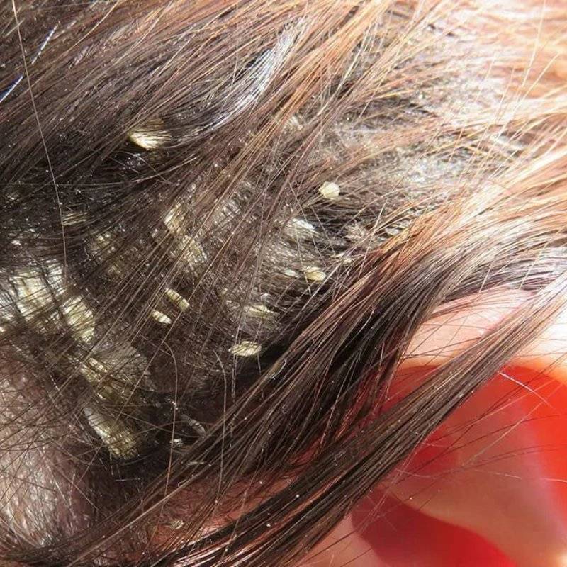 У ребенка перхоть и шелушение кожи головы: причины и лечение шампунями