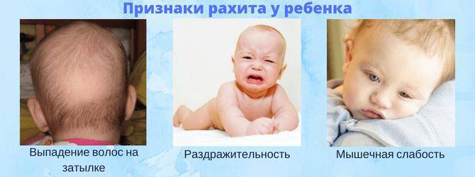 Рахит у грудничков: признаки, причины, симптомы и профилактика заболевания у новорождённых