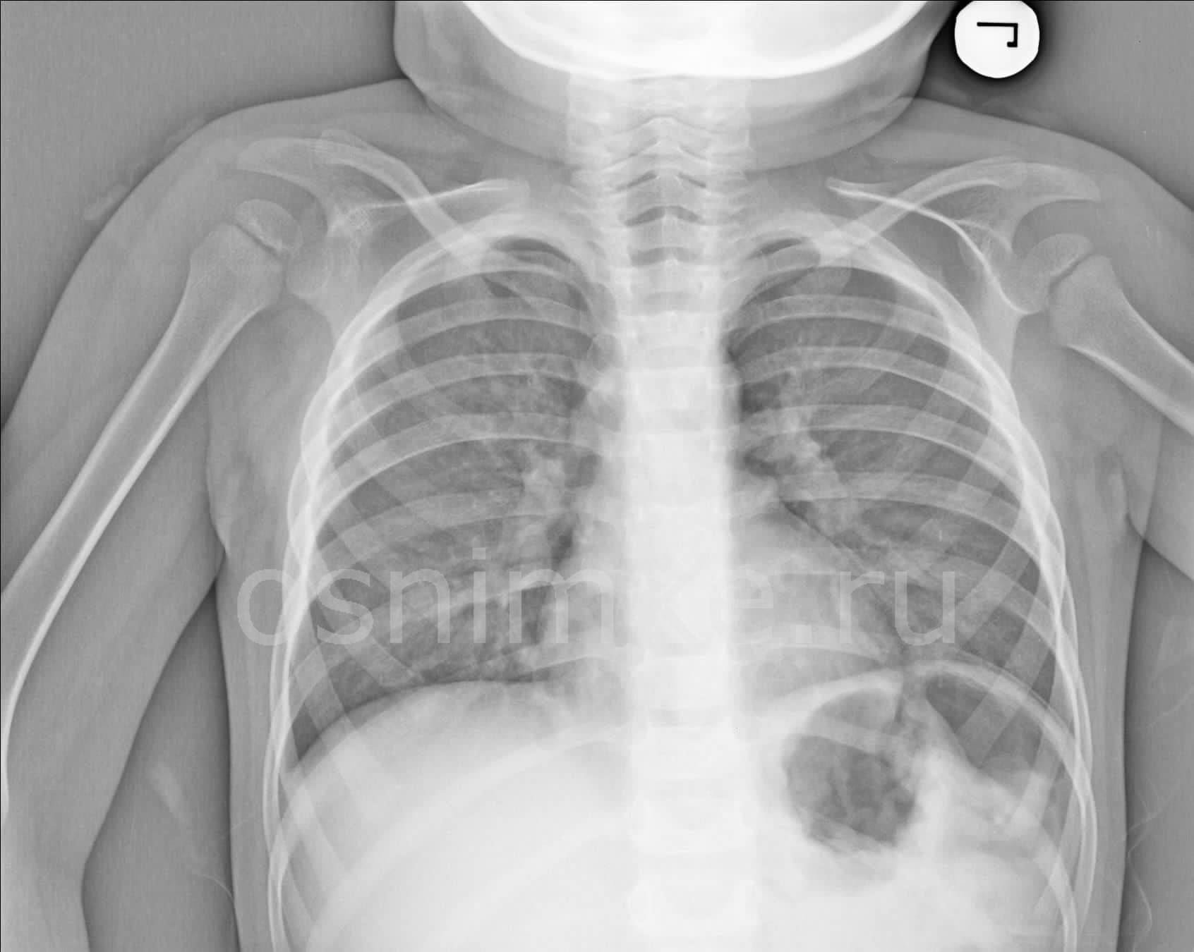 В каких случаях и с какого возраста делают рентген детям? когда назначается обследование, рентген с какого возраста не представляет угрозы для здоровья?