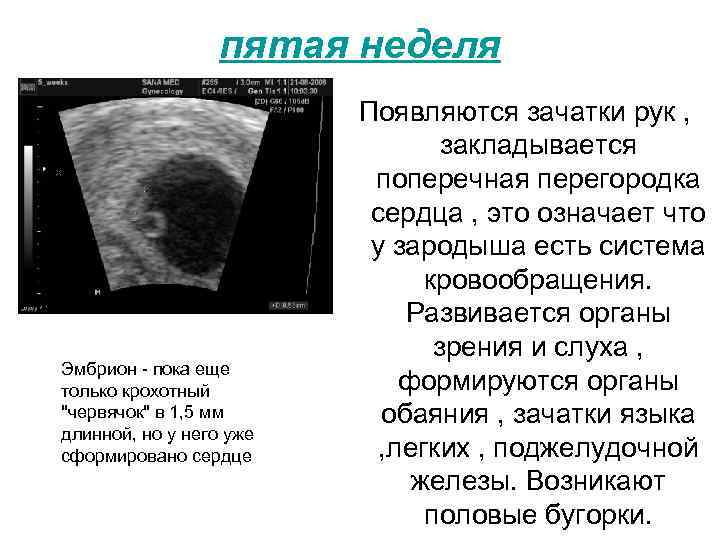 Эмбрион четко не визуализируется или не лоцируется: что это значит, почему на 5–6 неделе беременности не виден зародыш?