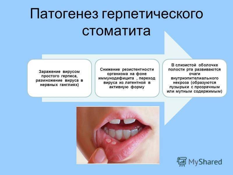 Герпес на губе  и другие типы герпетической инфекции