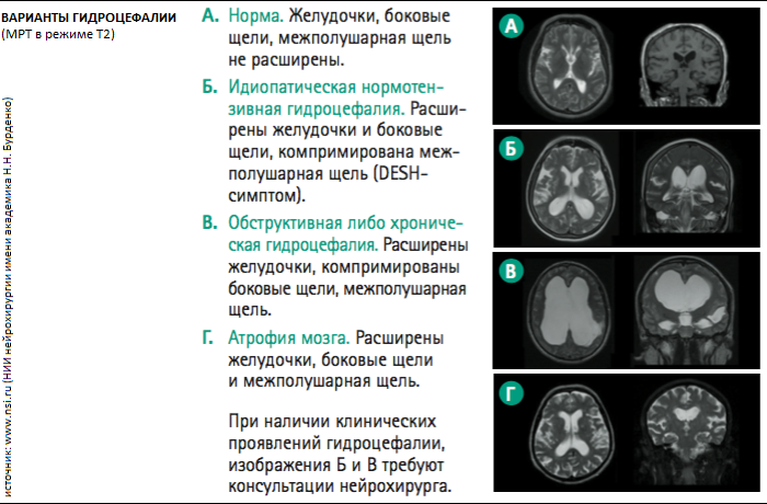 Синдром Хакима-Адамса нормотензивная гидроцефалия. Внутренняя гидроцефалия на кт головного мозга. Кт атрофия мозга наружная гидроцефалия. Клинические симптомы гидроцефалии.