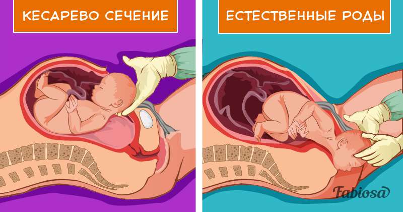 Естественные роды после кесарева сечения - можно ли рожать самой после кесарева - agulife.ru