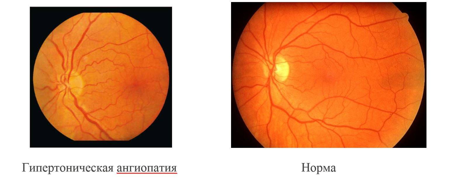 Ангиопатия сетчатки глаза - причины, симптомы и лечение - moscoweyes.ru - сайт офтальмологического центра "мгк-диагностик"