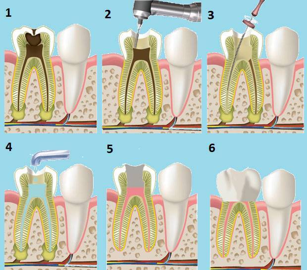 Чистка каналов зуба и временная пломба