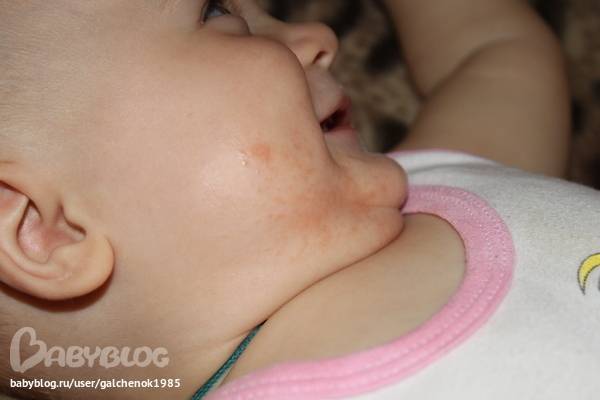 Аллергия у детей – причины, симптомы и лечение аллергии на коже у ребенка
