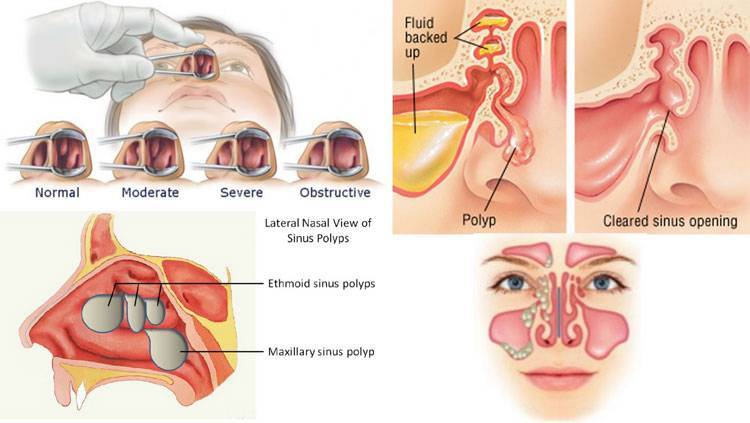 Полипы полости носа и околоносовых пазух (полипоз носа) - как лечить?