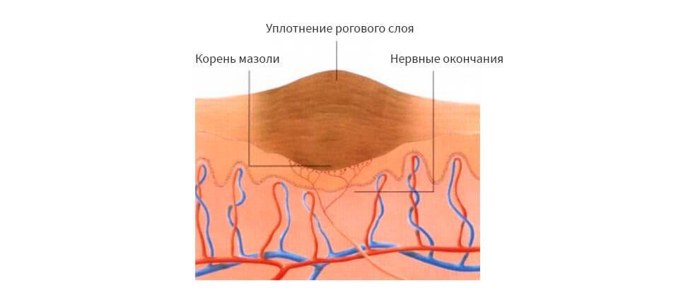 Водяная мозоль | симптомы | диагностика | лечение - docdoc.ru