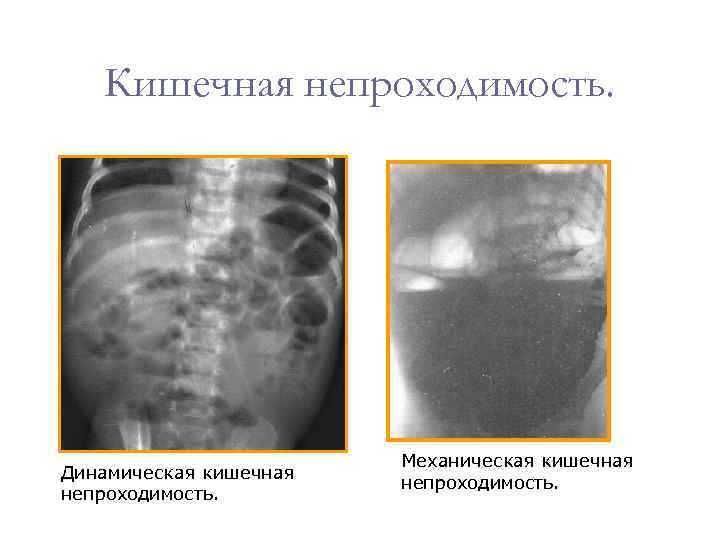 Кишечная непроходимость у детей карта вызова