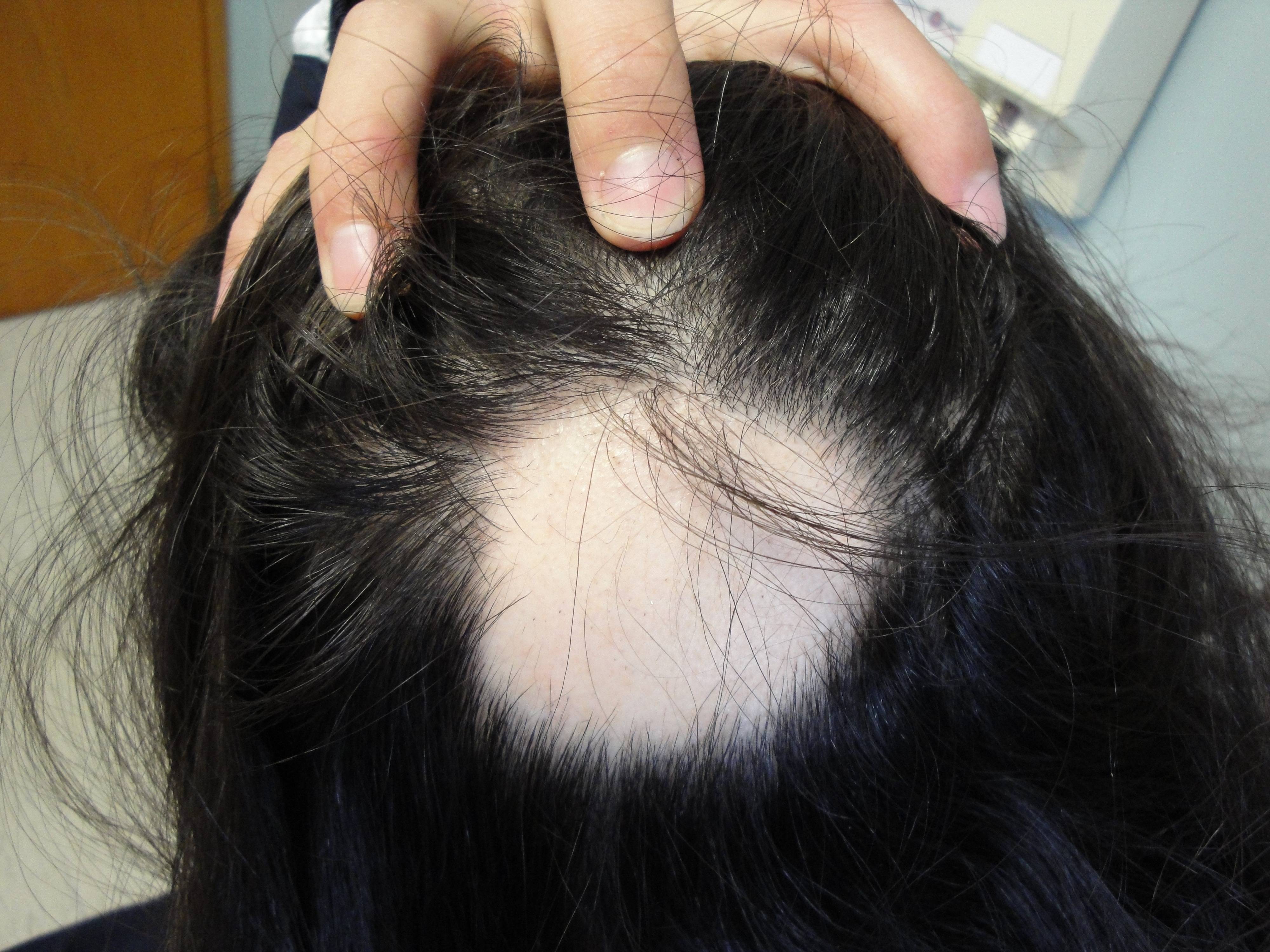 Врач гончарова татьяна: аутоиммунная алопеция - клиника «доктор волос»