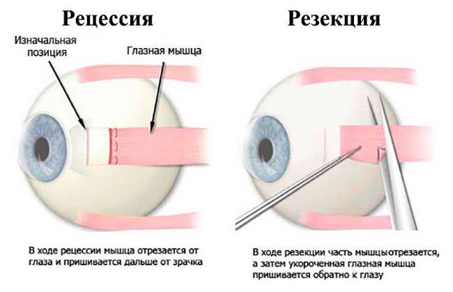 Что такое склеропластика глаз, особенности проведения процедуры у детей и взрослых