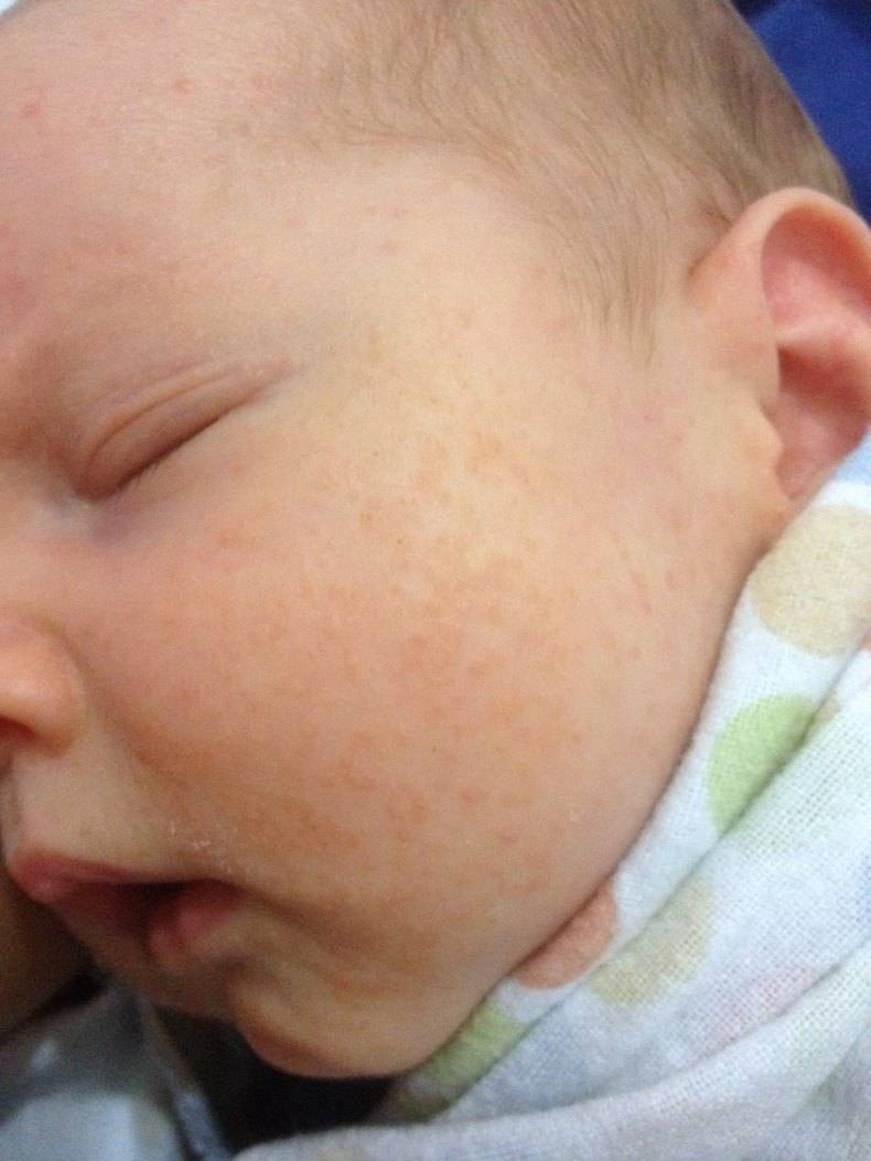У новорожденного сыпь на лице и голове: что это такое?