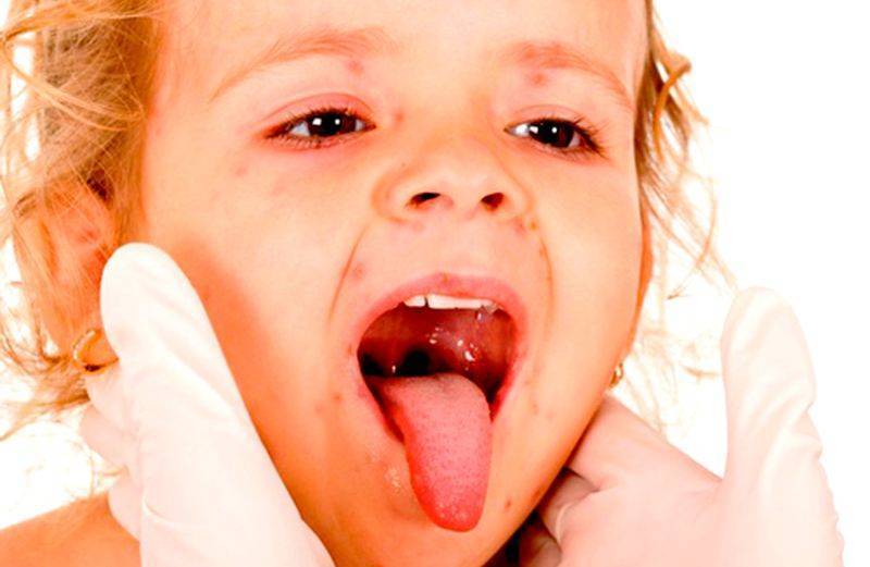 Стоматит у детей: виды, причины, симптомы, лечение, профилактика