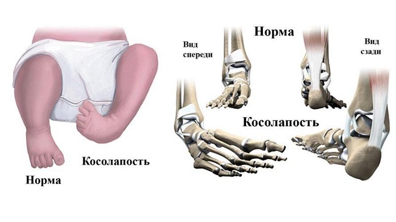 Косолапие у детей - лечение упражнениями лфк