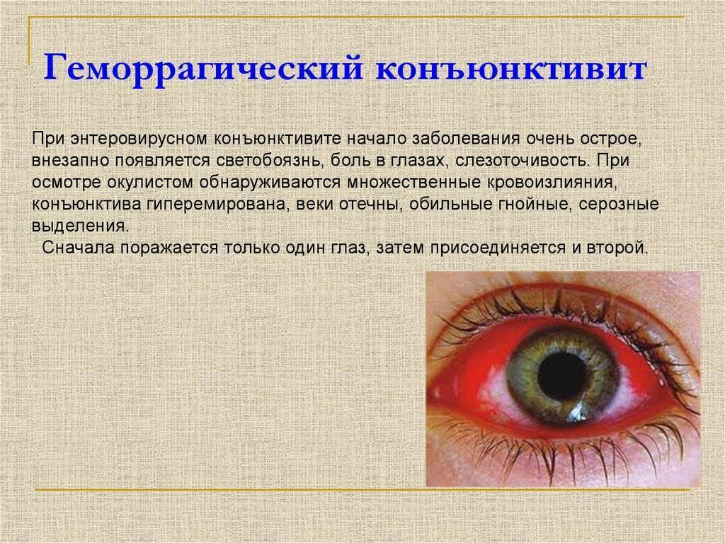 Аденовирусный конъюнктивит: лечение у взрослых, как себя проявляют симптомы на глазах в катаральной, фолликулярной, пленчатой формах
