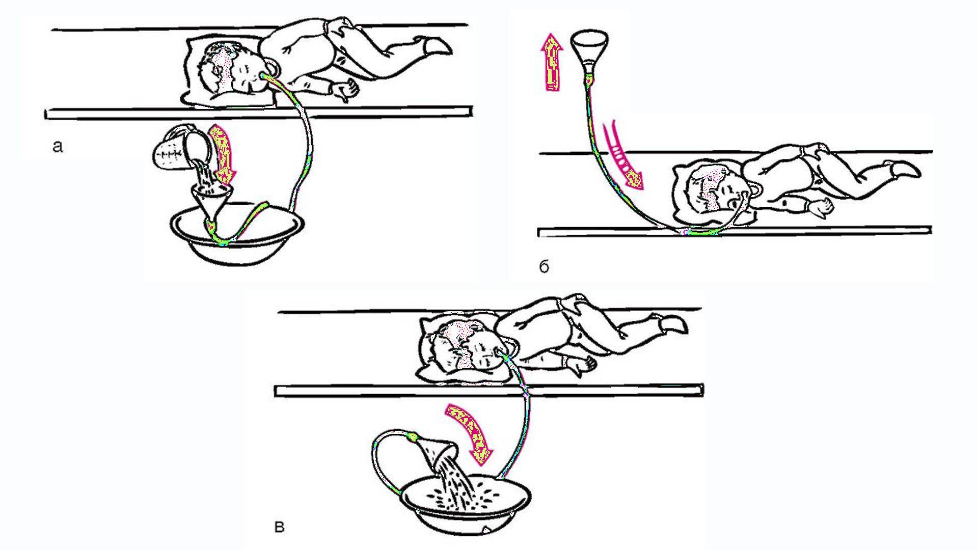 Промывание желудка ребенку: алгоритм процедуры у детей, в том числе новорожденных, как промыть в домашних условиях