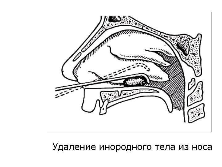 Что делать, если ребенок засунул в нос маленькую бусинку или другой инородный предмет?
