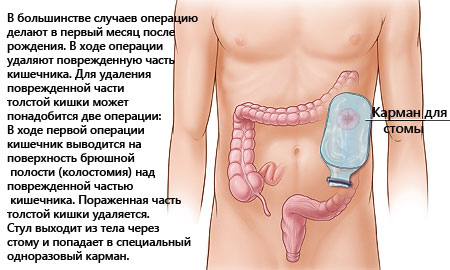 Болезнь гиршпрунга у детей: симптомы и лечение