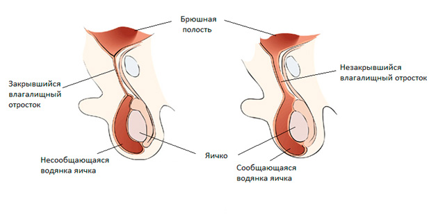 Лечение водянки яичек у новорожденных мальчиков