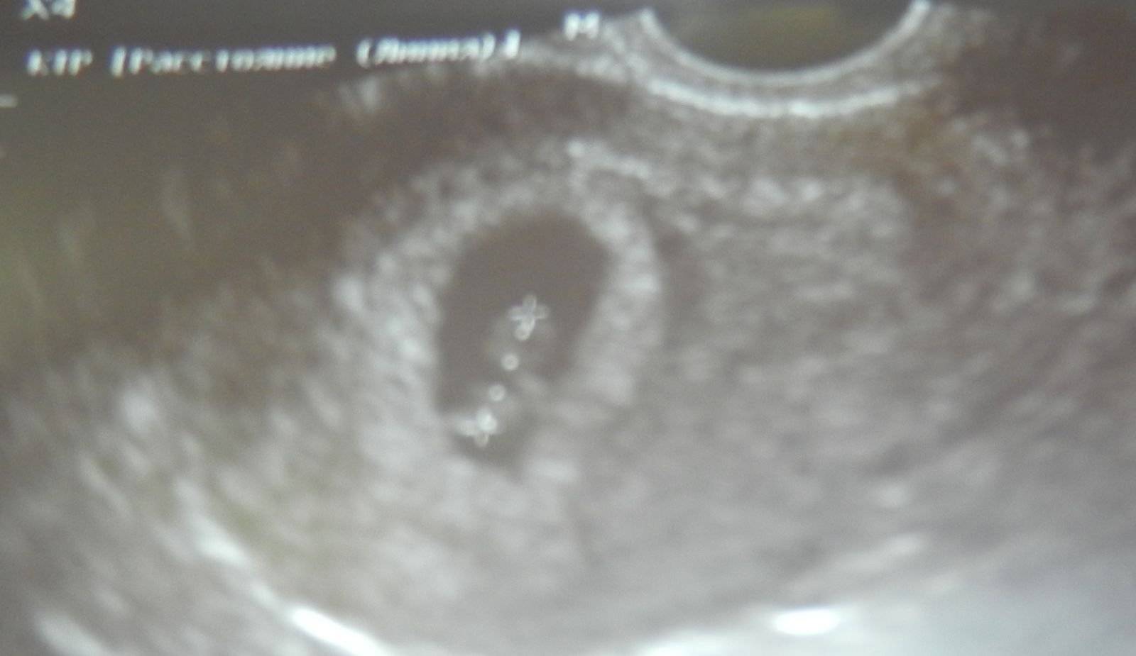 4 неделя беременности от зачатия: что происходит с малышом и мамой, каковы ощущения женщины?