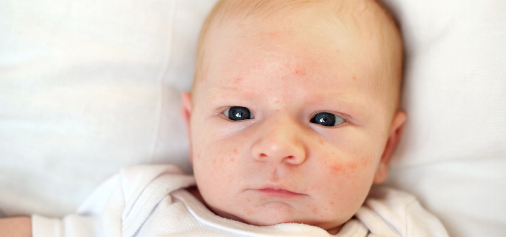 Опрелости у новорожденных: как выглядят и чем лечить | профилактика опрелостей у грудничка (на попе, шее, в паху, на ногах)