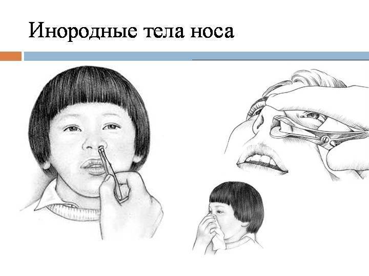 У ребенка предмет в носу: что делать? - mamapedia