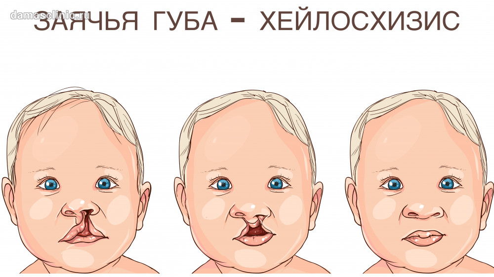 Что такое заячья губа и как это исправить?