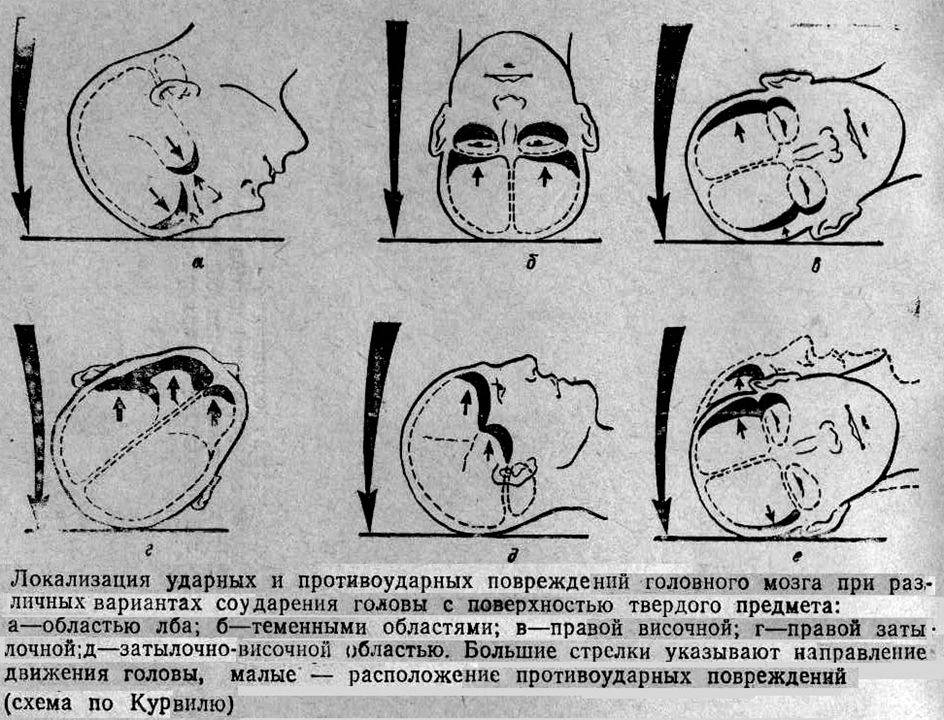 Какие могут быть последствия черепно-мозговых травм у детей?