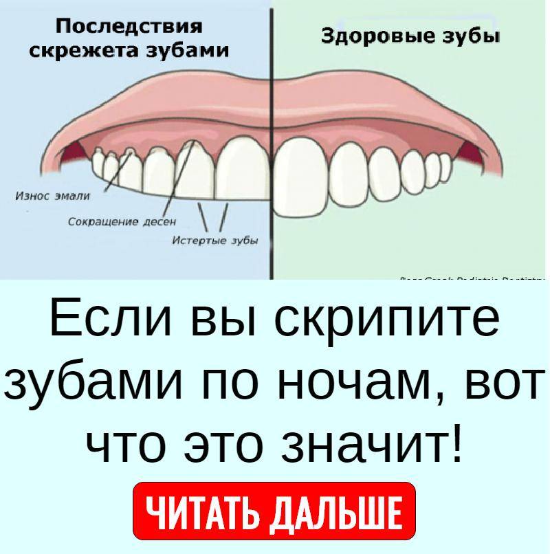 Бруксизм - непроизвольный скрежет зубами |