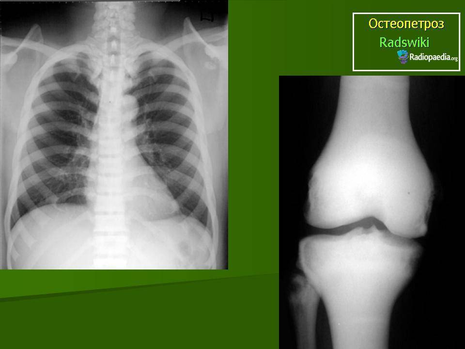 Остеопетроз (мраморная болезнь) | клиника хадасса