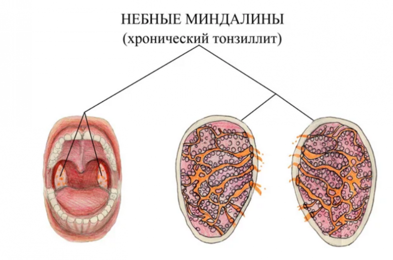 Хронический тонзиллит у детей: причины, симптомы, лечение и профилактика