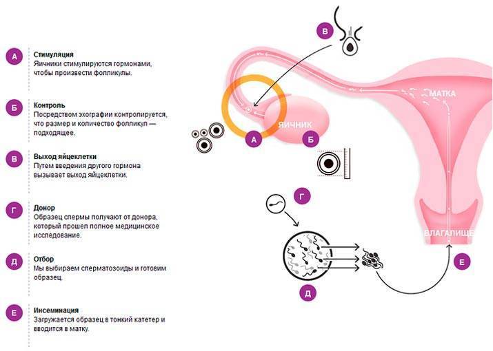 Инсеминация. Схема экстракорпорального оплодотворения. Схема искусственной инсеминации. Искусственная инсеминация донором. Инсеминация ооцитов.