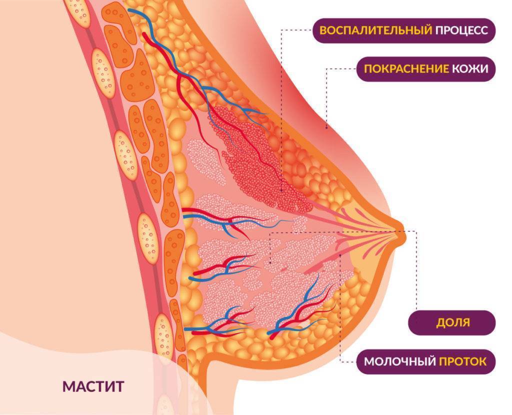 может ли при мастите не болеть грудь фото 7