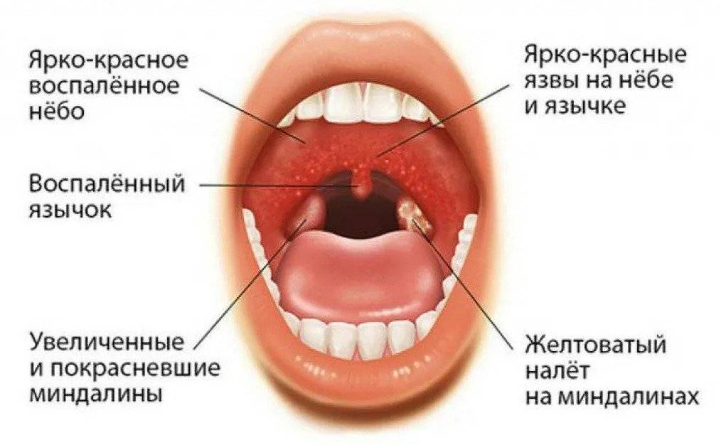 Ангина у детей – симптомы и лечение. как и чем лечить ангину у ребенка