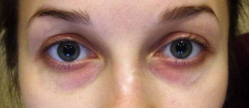 ᐈ почему у детей появляются синяки под глазами?| медицентр (доктор лор)