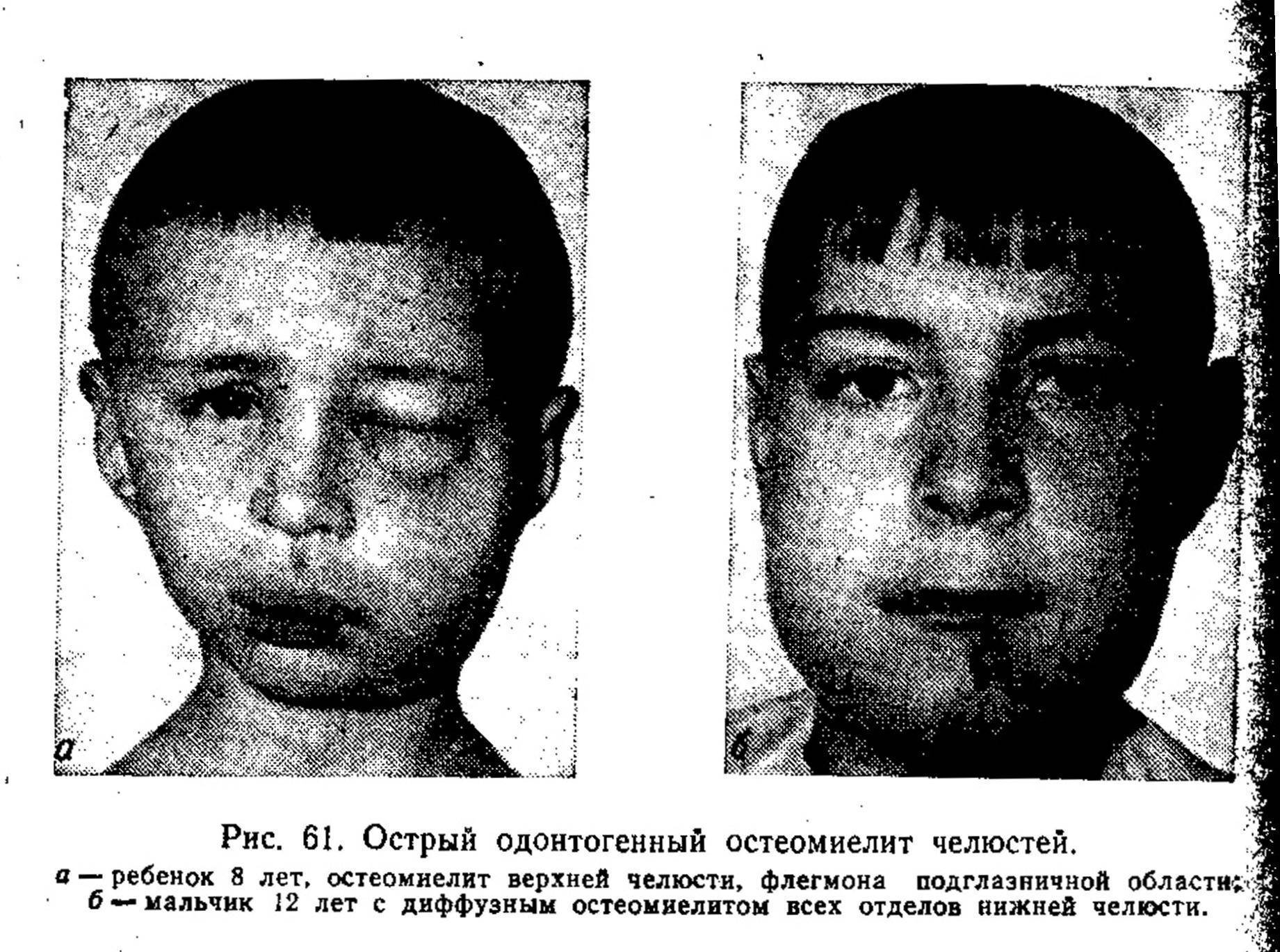Остеомиелит. причины, симптомы, признаки, диагностика и лечение