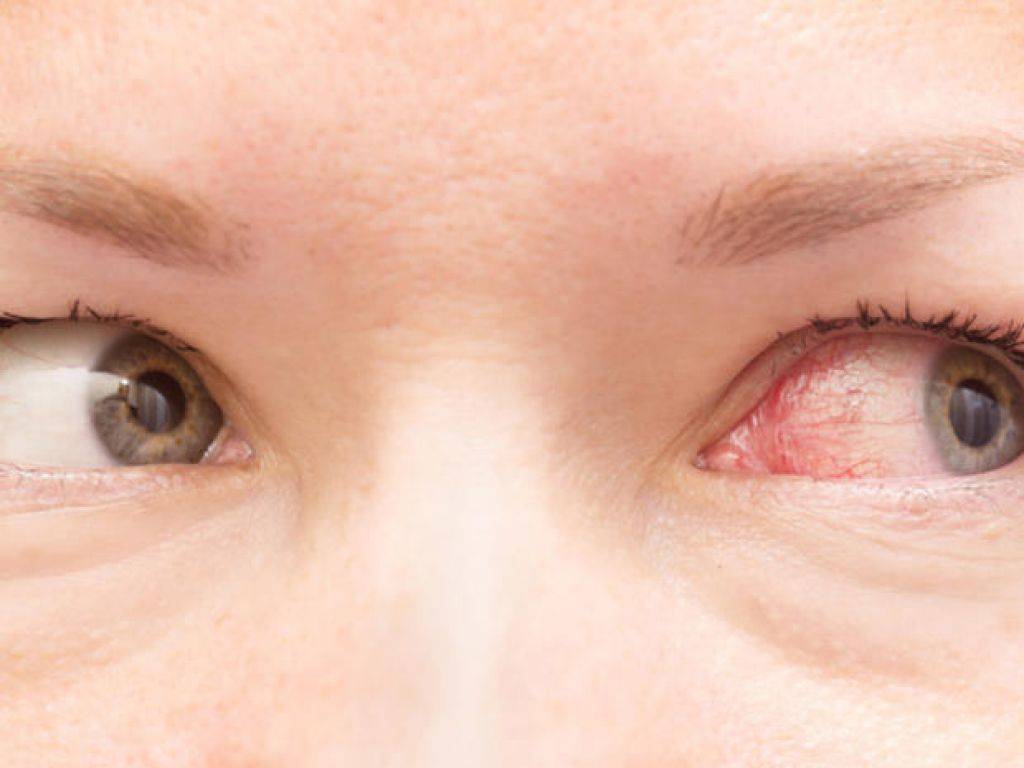 Почему лопаются капилляры в глазах