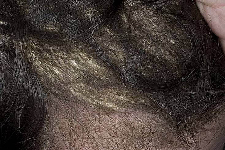 Лечение себореи волосистой части головы
