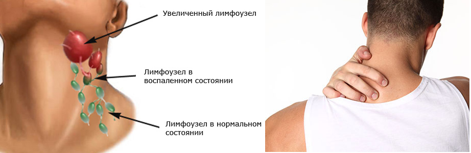 Лимфома у детей