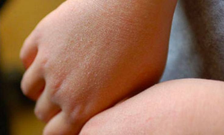 Сухая кожа рук и тела у новорожденного: почему и что делать