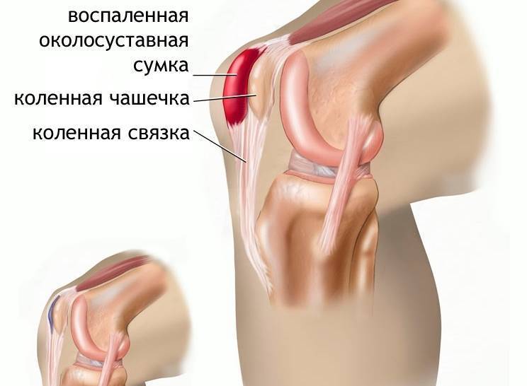 Почему болит колено у женщины: главные причины - нолтрекс.