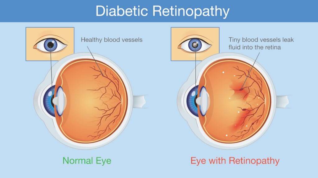 Фоновая ретинопатия и ретинальные сосудистые изменения