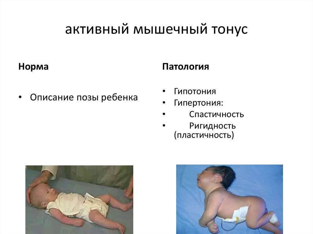 Лечение гипертонуса мышц у ребенка в оренбурге у невролога