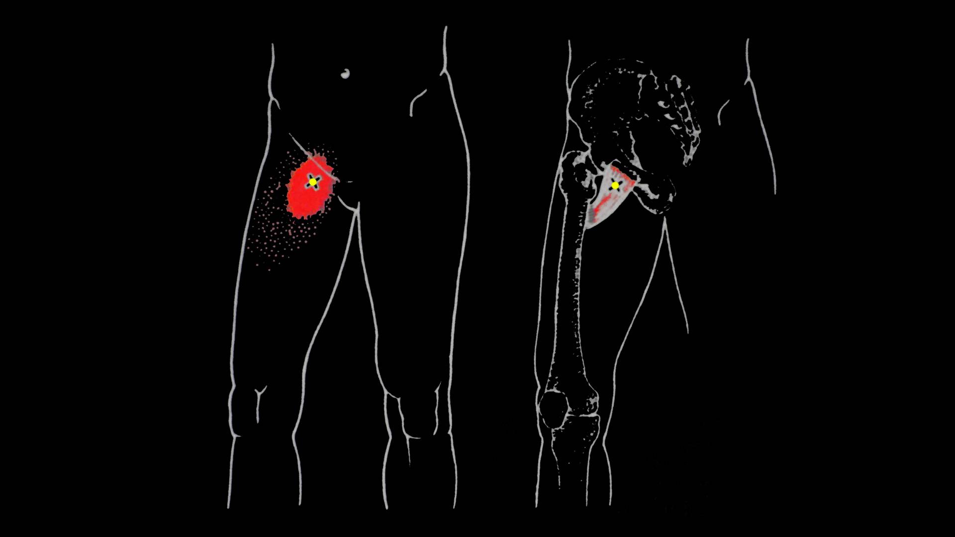 Кокцигодиния: боль в области копчика, крестца, ягодиц, промежности. лечение кокцигодинии, в т.ч. при беременности