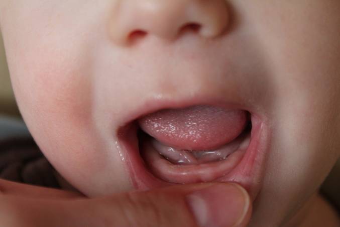 Прорезывание зубов у детей: фото десны и признаки ее набухания у младенца